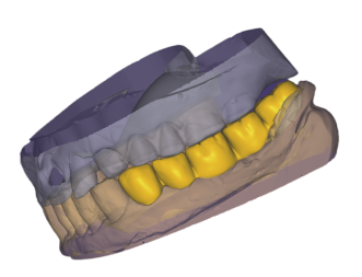 2025-02-04_00006-010-freeform-autosave.dentalCADscreenshot