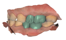 2025-05-19_00020-001_DentalCadScreenshot
