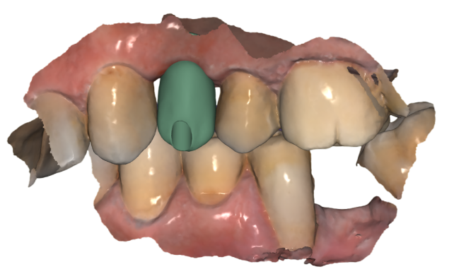 crown implant