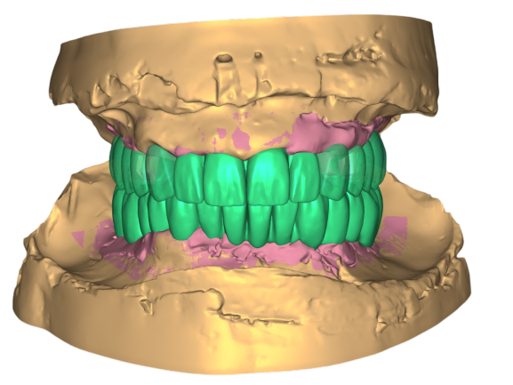 full mouth 1