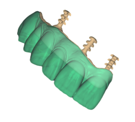 implant